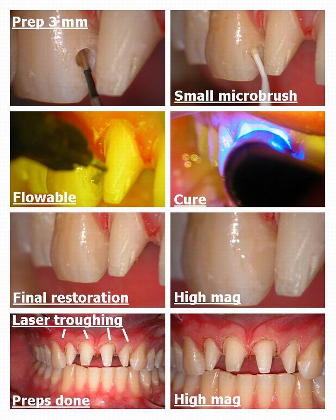 Resize of Laser recontouring with erbium pg 3.jpg